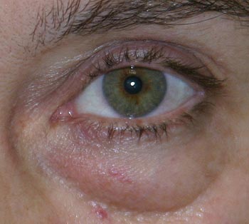 Unter den Augen bedeutet was die Falten