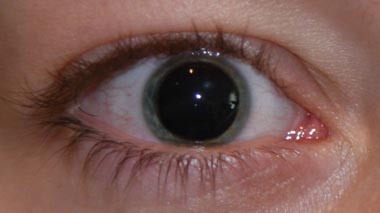 http://www.auge-online.de/Diagnostik/Netzhautuntersuchung/weitePupille.jpg
