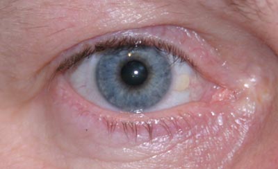 Die Masken von der Pigmentation für die Person von den schwarzen Punkten