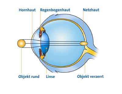 Hornhautverkr�mmung