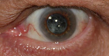 die Operation des Grauen Stars