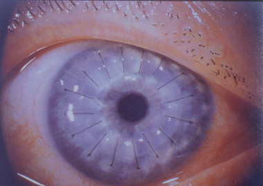 Arcus Corneae