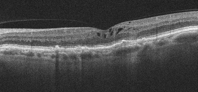 Intravitreale Injektion