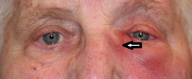 Es ist das Auge der Lippen dass dieser solches angeschwollen