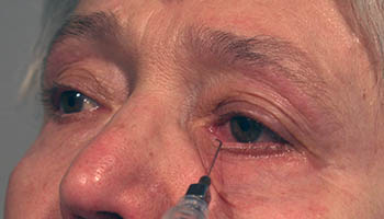 Wie die Falten um die Augen und vom Hals zu entfernen