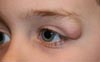 Die Blepharoplastik des Oberlides laser-