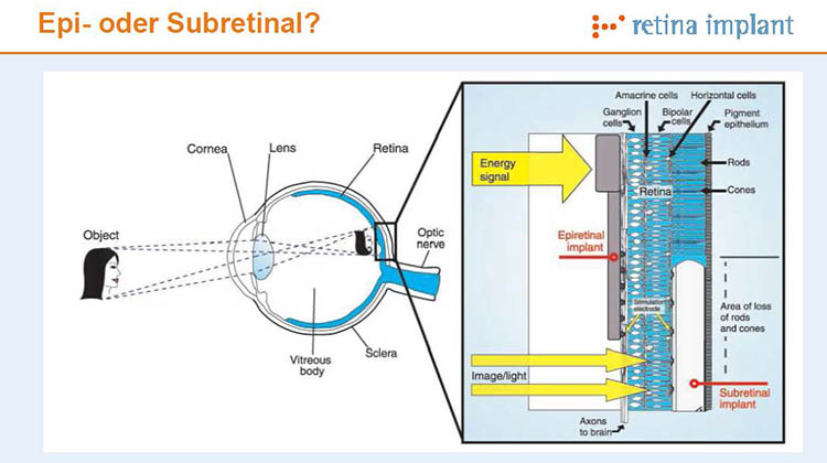 Epi oder subretinal