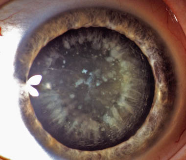 Rindencataract