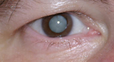 weiße Cataract
