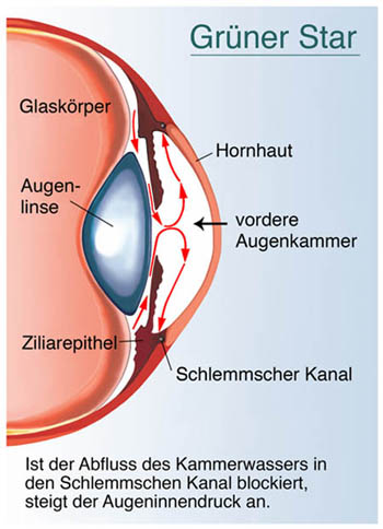 Schema Grüner Star (Weitwinkelglaukom)