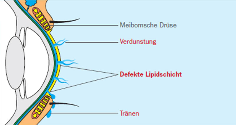 Tränenfilm mit defekter Lipidschicht