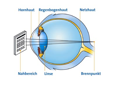 Altersweitsichtigkeit