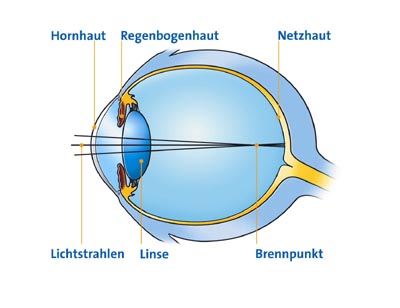 Kurzsichtigkeit