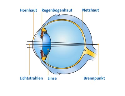 Weitsichtigkeit