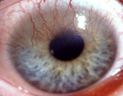 Gefäßeinsprossung durch Kontaktlinsen, massiv (BVA)