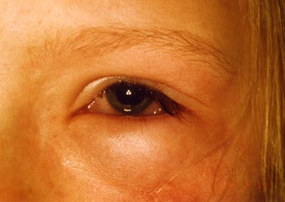 Allergische Reaktion am Auge (Chemosis)