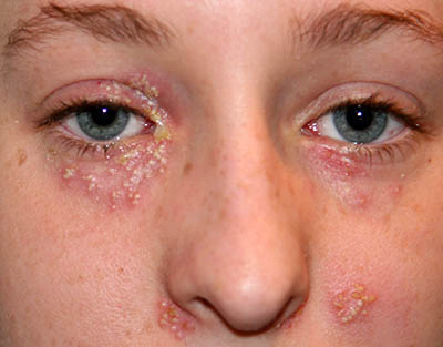 Herpes simplex im Gesicht