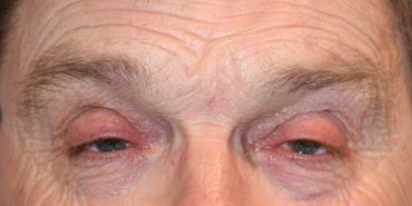 Ptosis