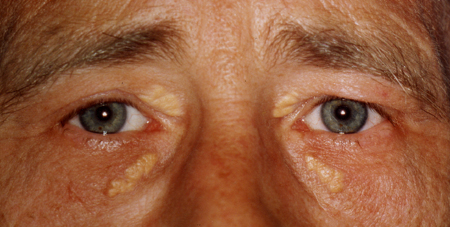 Xanthelasma bei Mann