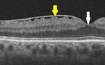 Epiretinale Gliose im OCT