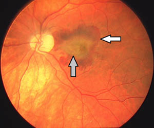 feuchte Makulopathie mit Blutung