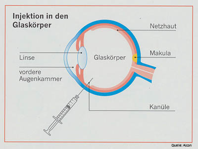 Intravitreale Injektion im Schema