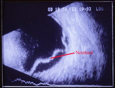 Netzhautablösung im Ultraschall