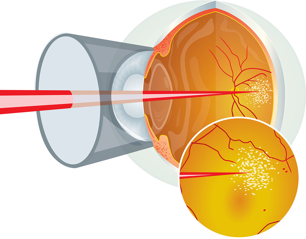 Netzhautlaser