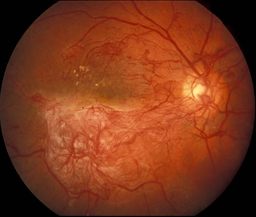  Photo proliferative diabetische Retinopathie