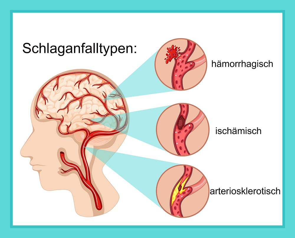 Schlaganfalltypen