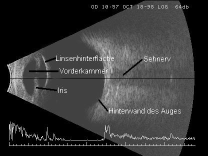 Ultraschallquerschnitt des Augesd