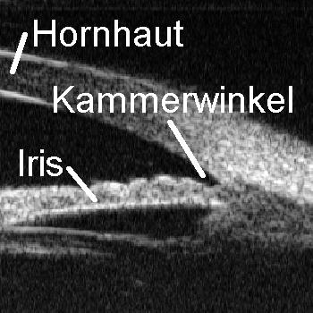 Ultraschallbild des Kammerwinkels