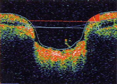 ausgehöhlter Sehnervenkopf im OCT-Bild