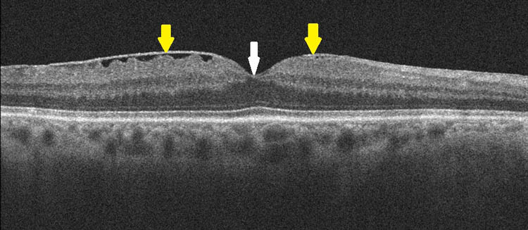 Epiretinale Gliose im OCT