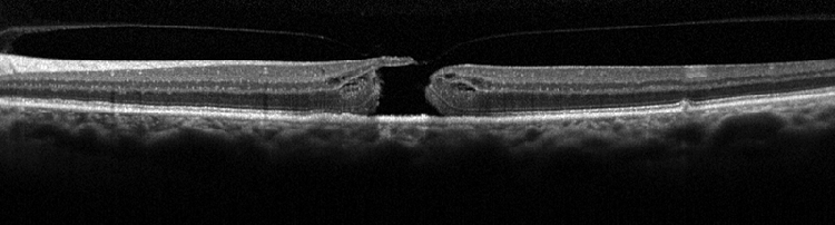 Makulaforamen im OCT