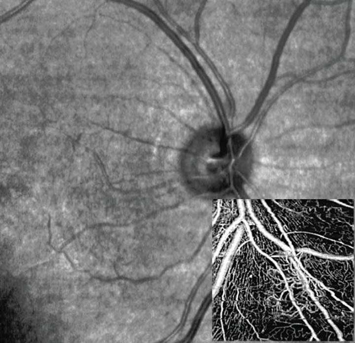 OCT-Angiographie 2