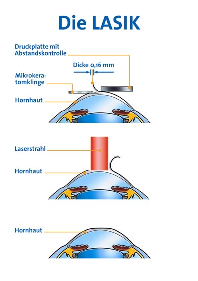 Schema Lasikoperation