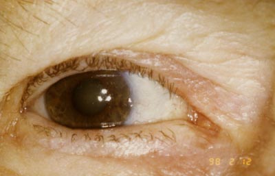 4 Wochen nach Entfernung mit Hochfrequenzchirurgie