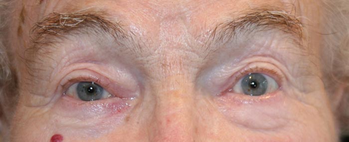 Ptosis nach der Operation