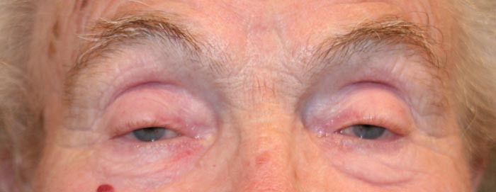 Ptosis vor der Operation