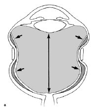 Cerclage