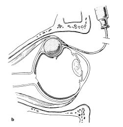 Ballontamponade